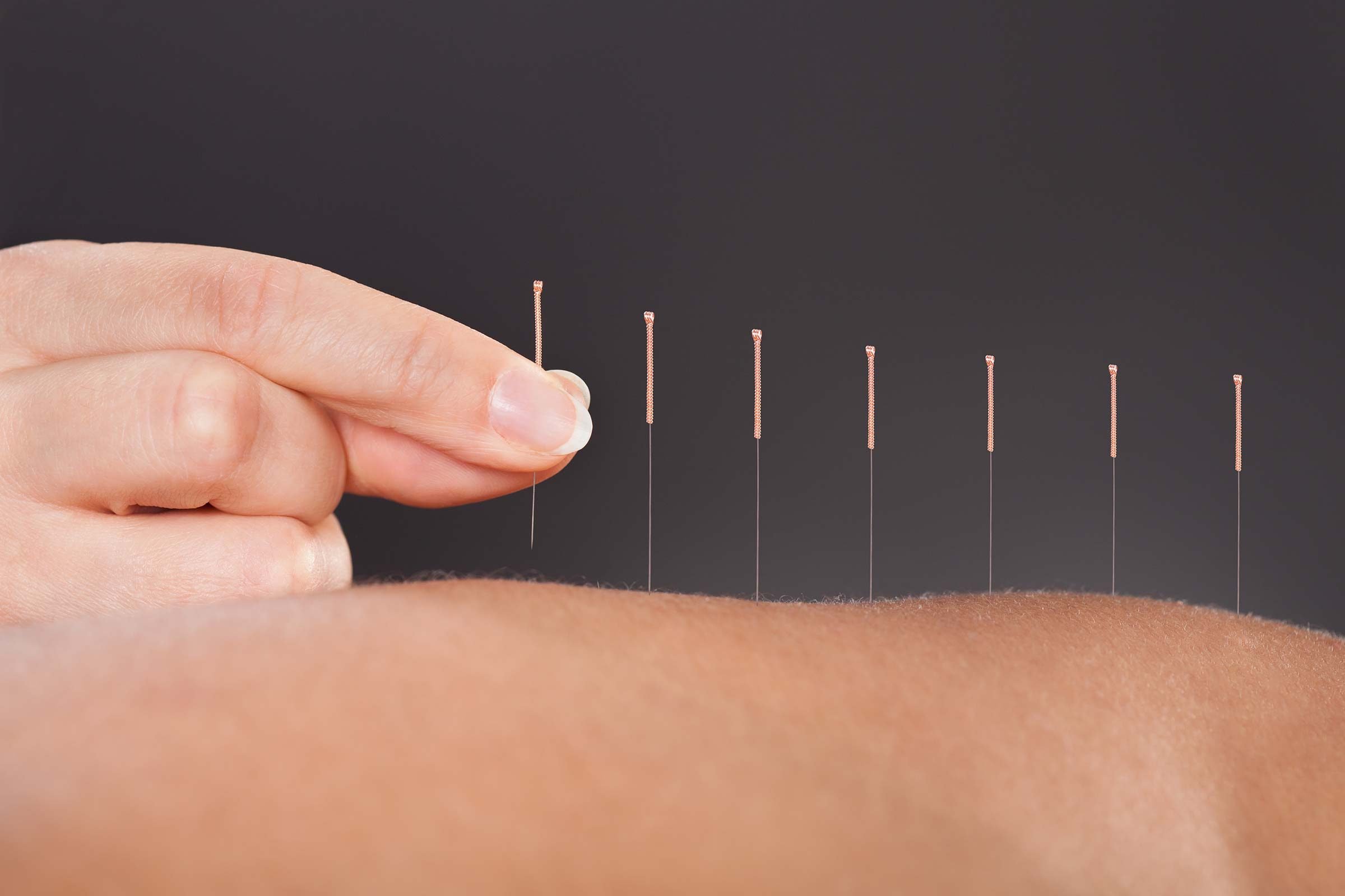 Acupuncture image